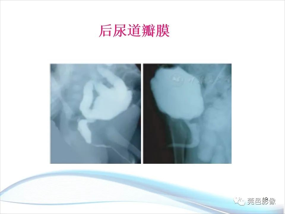 影像PPT - 【PPT】儿童膀胱造影流程及常见疾病诊断-19