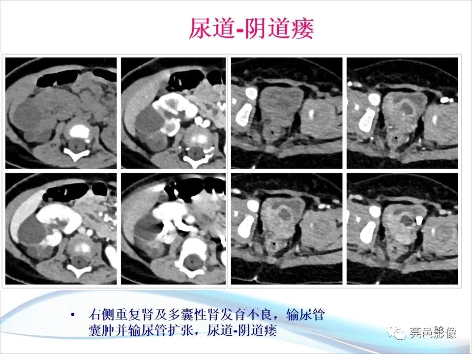 影像PPT - 【PPT】儿童膀胱造影流程及常见疾病诊断-28