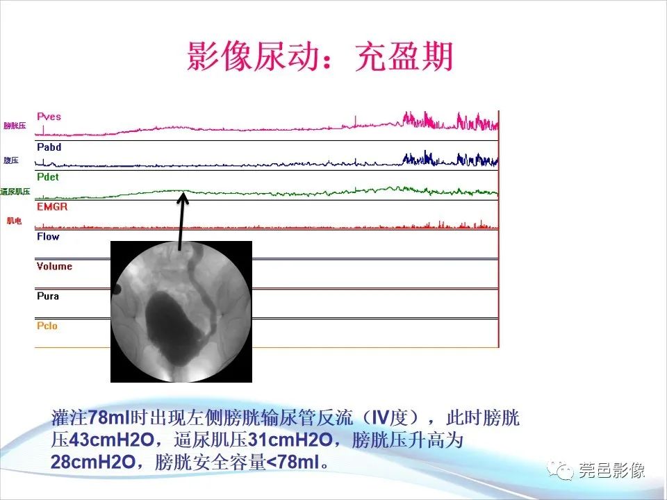 影像PPT - 【PPT】儿童膀胱造影流程及常见疾病诊断-47