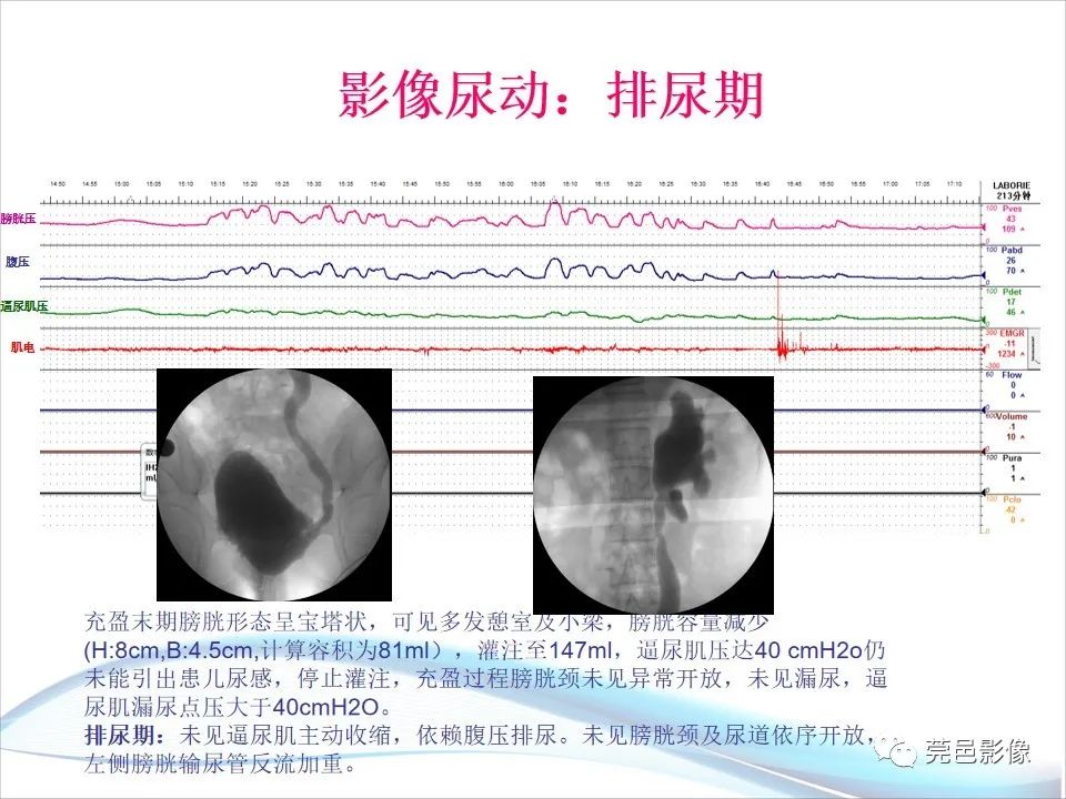 影像PPT - 【PPT】儿童膀胱造影流程及常见疾病诊断-48