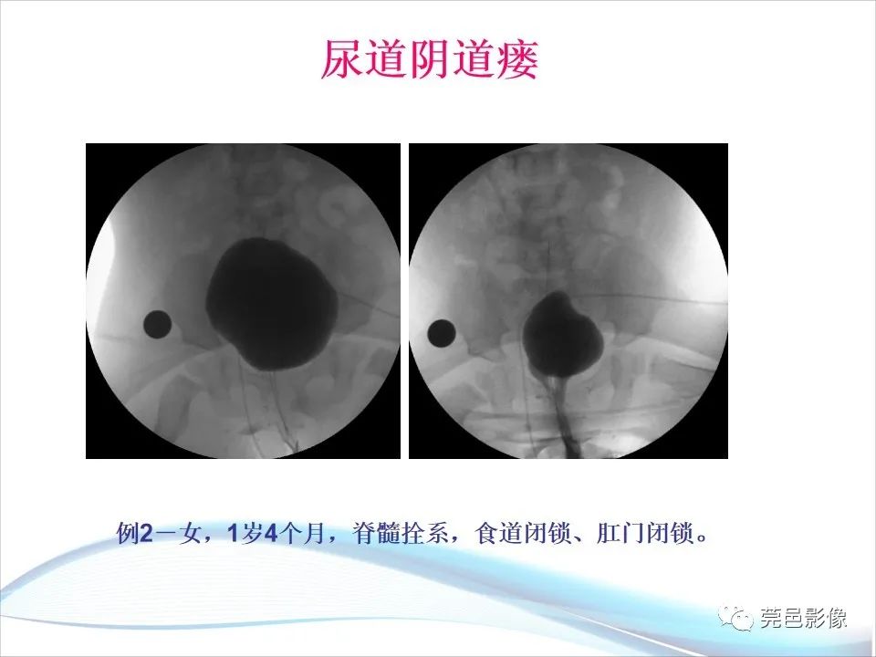 影像PPT - 【PPT】儿童膀胱造影流程及常见疾病诊断-29