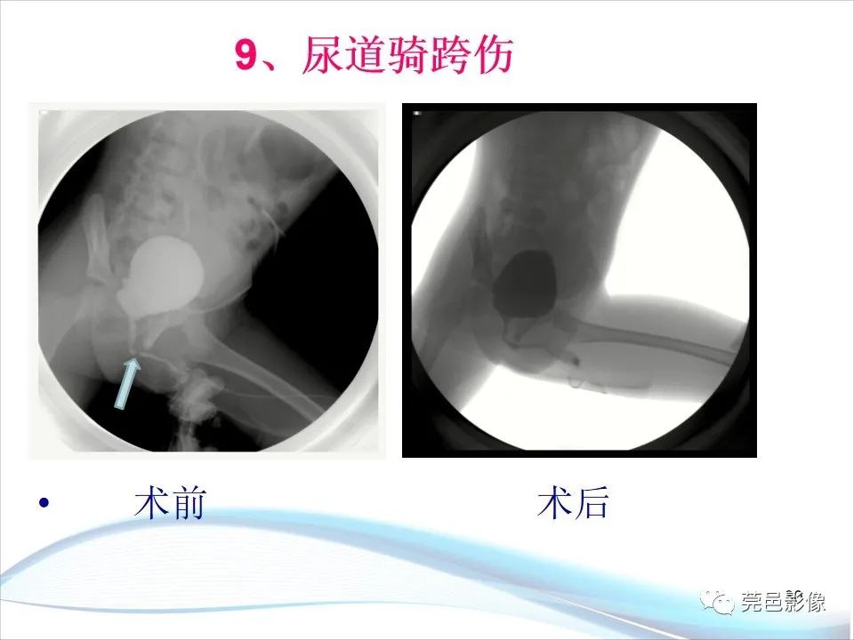 影像PPT - 【PPT】儿童膀胱造影流程及常见疾病诊断-30