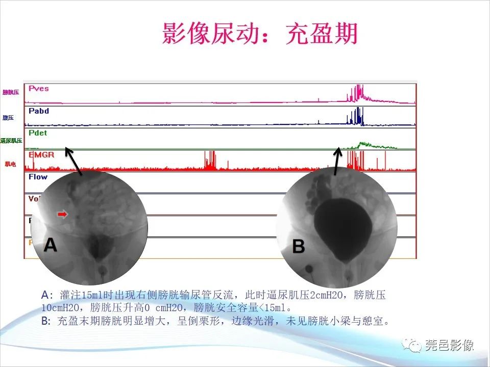 影像PPT - 【PPT】儿童膀胱造影流程及常见疾病诊断-42