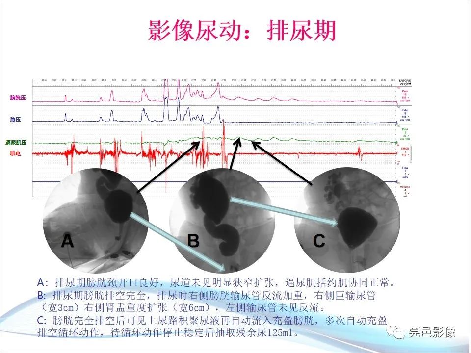 影像PPT - 【PPT】儿童膀胱造影流程及常见疾病诊断-43