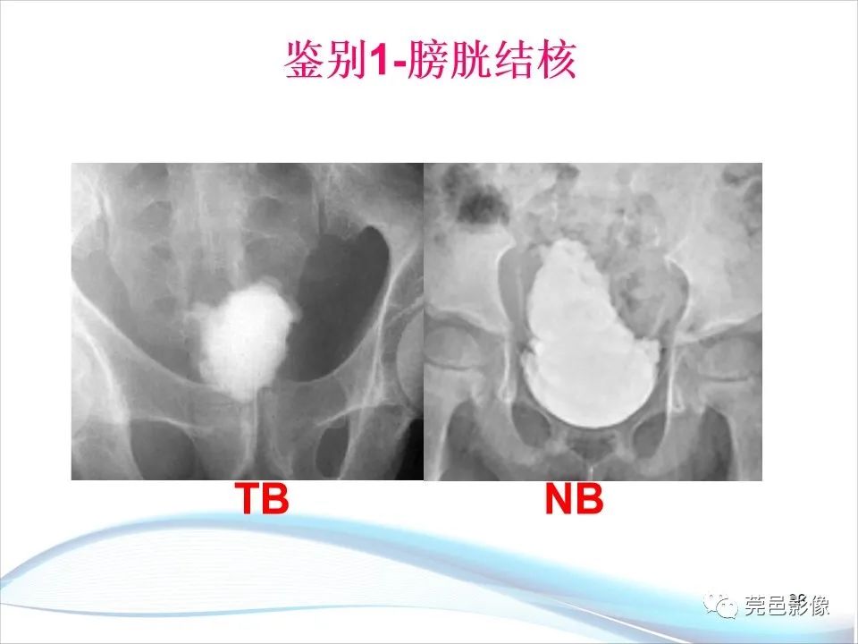 影像PPT - 【PPT】儿童膀胱造影流程及常见疾病诊断-38