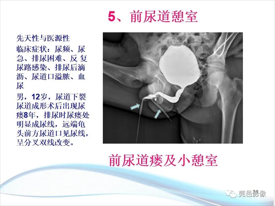 影像PPT - 【PPT】儿童膀胱造影流程及常见疾病诊断-21