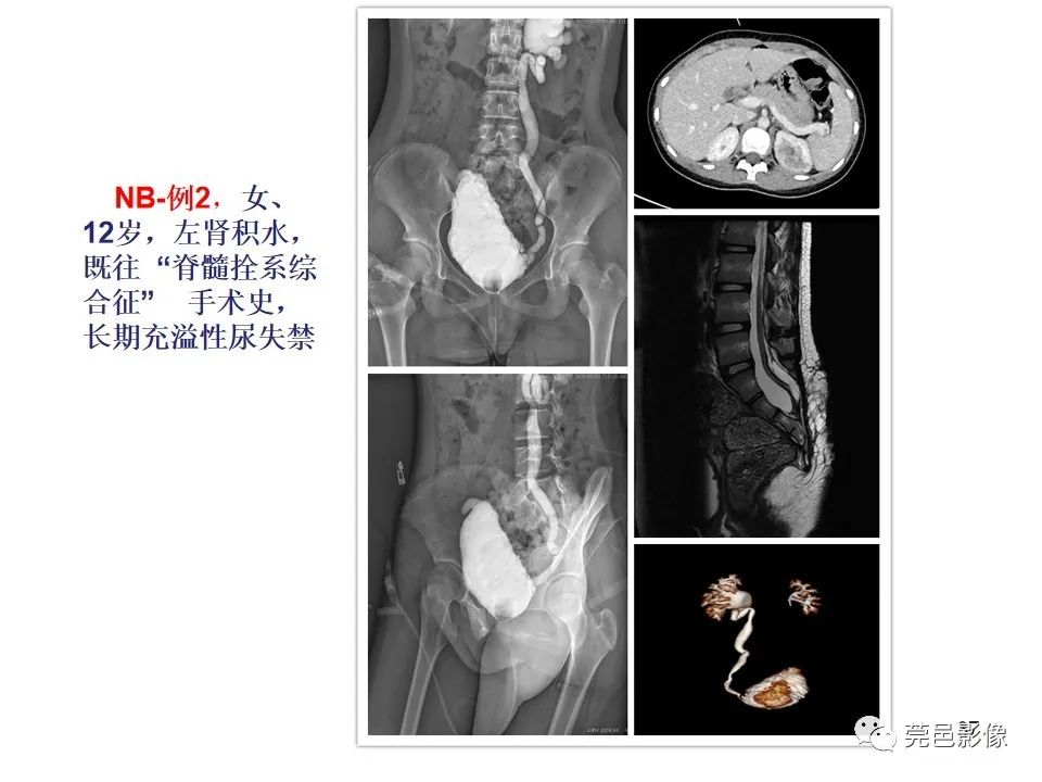 影像PPT - 【PPT】儿童膀胱造影流程及常见疾病诊断-37