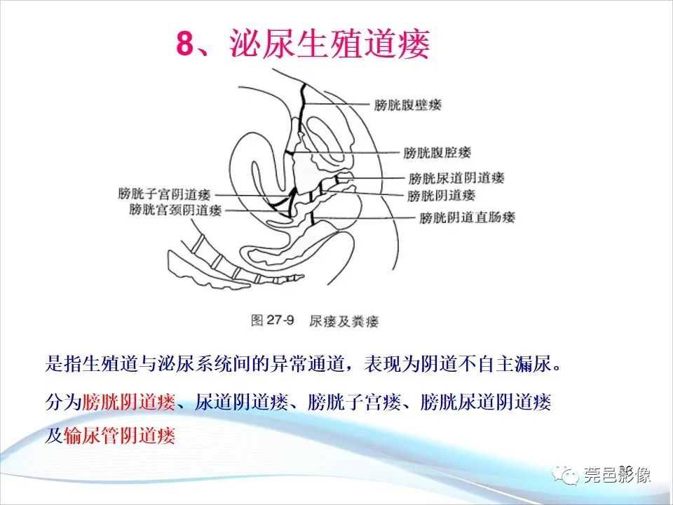 影像PPT - 【PPT】儿童膀胱造影流程及常见疾病诊断-26