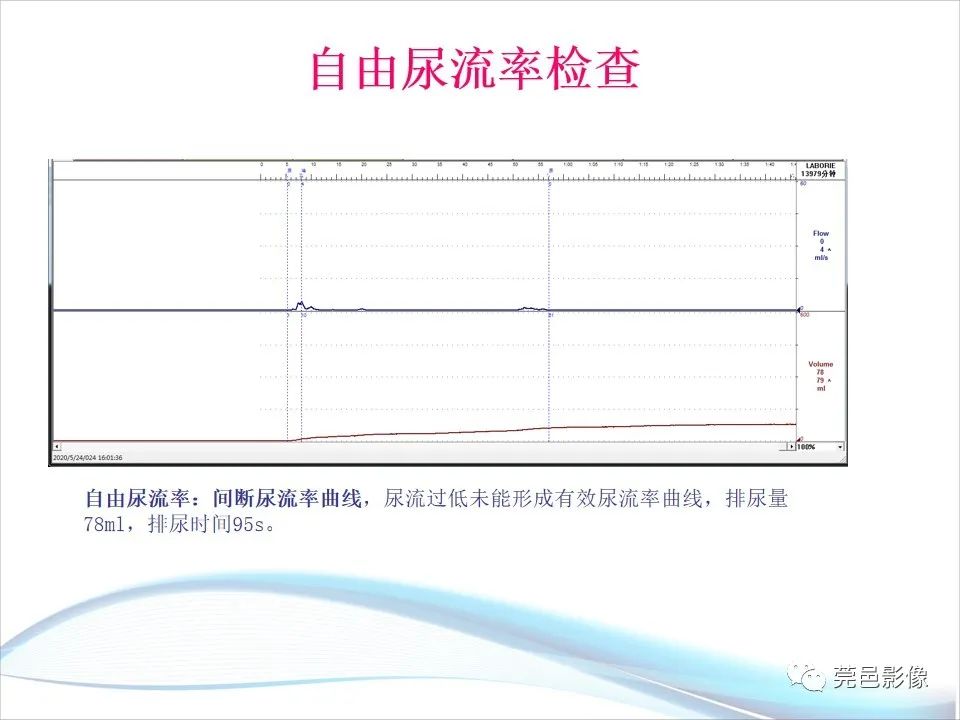 影像PPT - 【PPT】儿童膀胱造影流程及常见疾病诊断-46