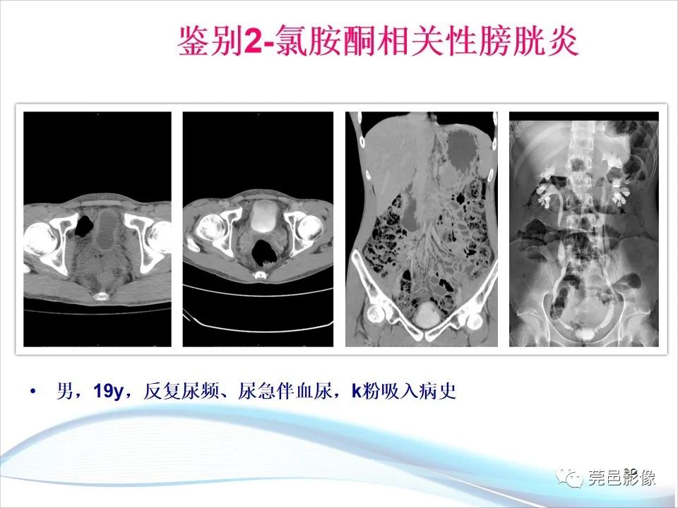 影像PPT - 【PPT】儿童膀胱造影流程及常见疾病诊断-39