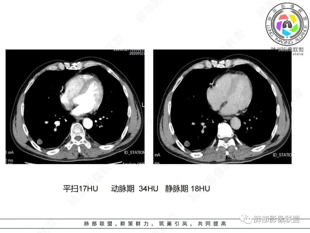 影像PPT - 【病例】肺内光滑实性结节的分析-7 影像PPT - 【病例】肺内光滑实性结节的分析-7