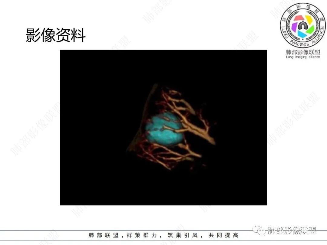 影像PPT - 【病例】肺内光滑实性结节的分析-11 影像PPT - 【病例】肺内光滑实性结节的分析-11