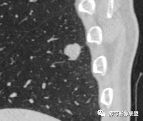 影像PPT - 【病例】肺内光滑实性结节的分析-16 影像PPT - 【病例】肺内光滑实性结节的分析-16