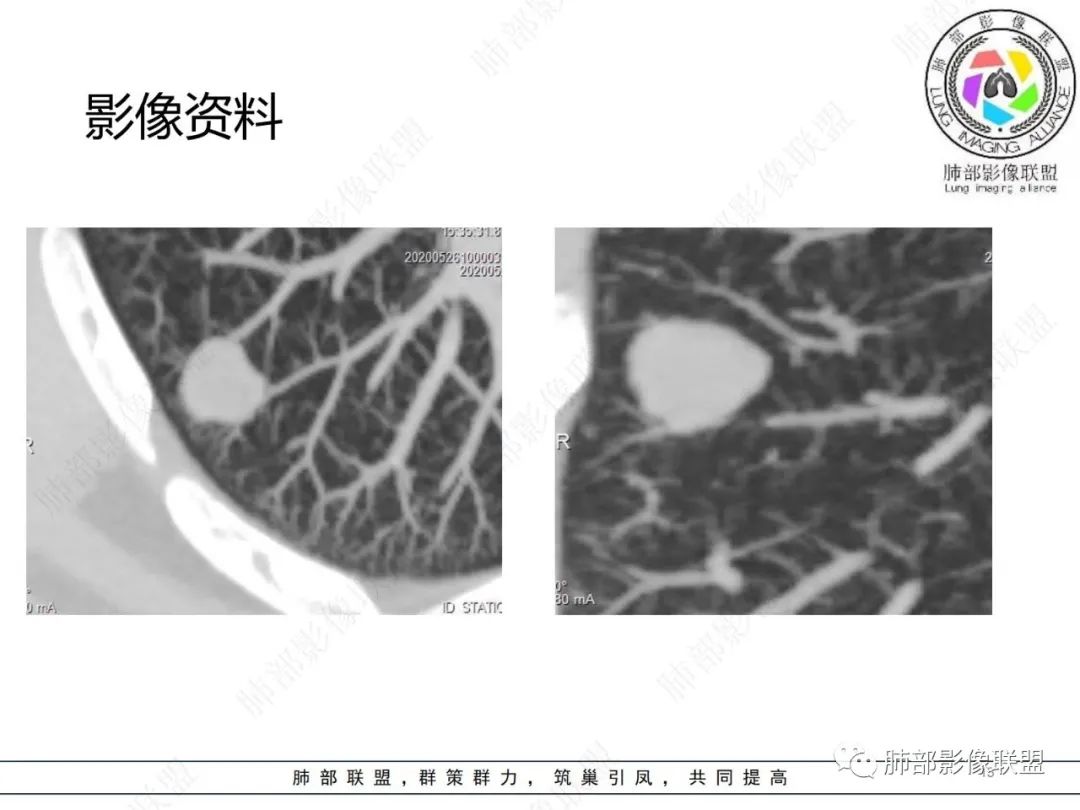 影像PPT - 【病例】肺内光滑实性结节的分析-13 影像PPT - 【病例】肺内光滑实性结节的分析-13