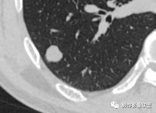 影像PPT - 【病例】肺内光滑实性结节的分析-17 影像PPT - 【病例】肺内光滑实性结节的分析-17