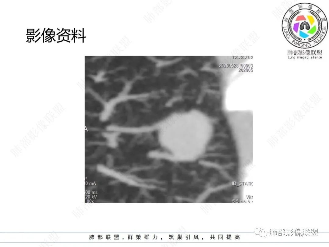 影像PPT - 【病例】肺内光滑实性结节的分析-14 影像PPT - 【病例】肺内光滑实性结节的分析-14