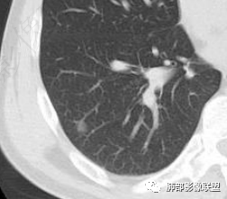 影像PPT - 【病例】肺内光滑实性结节的分析-18 影像PPT - 【病例】肺内光滑实性结节的分析-18