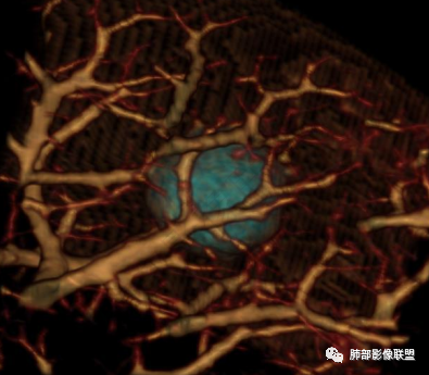 影像PPT - 【病例】肺内光滑实性结节的分析-19 影像PPT - 【病例】肺内光滑实性结节的分析-19