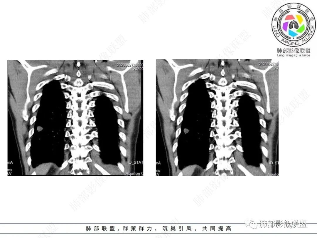 影像PPT - 【病例】肺内光滑实性结节的分析-8 影像PPT - 【病例】肺内光滑实性结节的分析-8