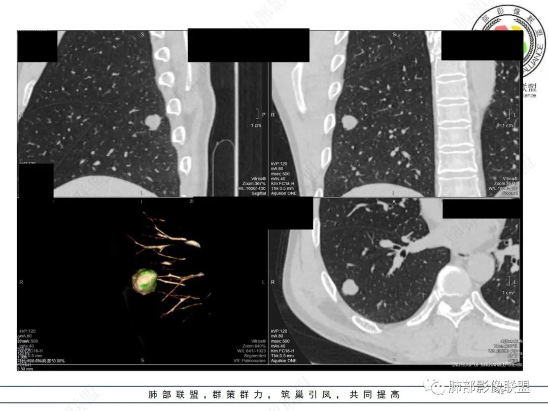 影像PPT - 【病例】肺内光滑实性结节的分析-12 影像PPT - 【病例】肺内光滑实性结节的分析-12