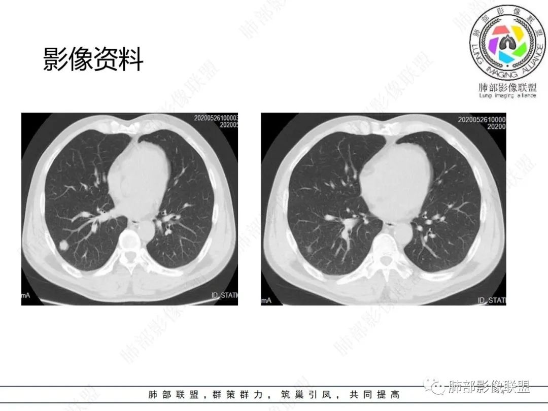 影像PPT - 【病例】肺内光滑实性结节的分析-4 影像PPT - 【病例】肺内光滑实性结节的分析-4