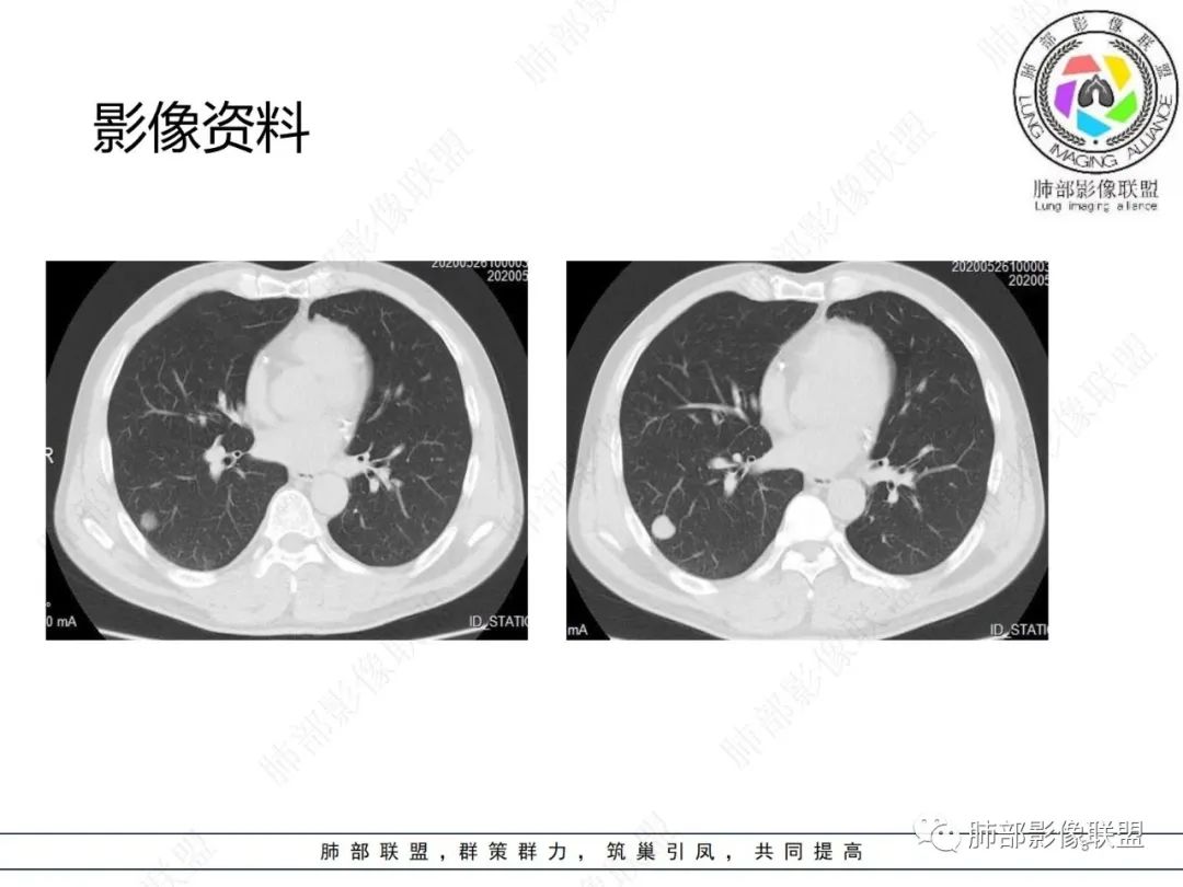 影像PPT - 【病例】肺内光滑实性结节的分析-3 影像PPT - 【病例】肺内光滑实性结节的分析-3