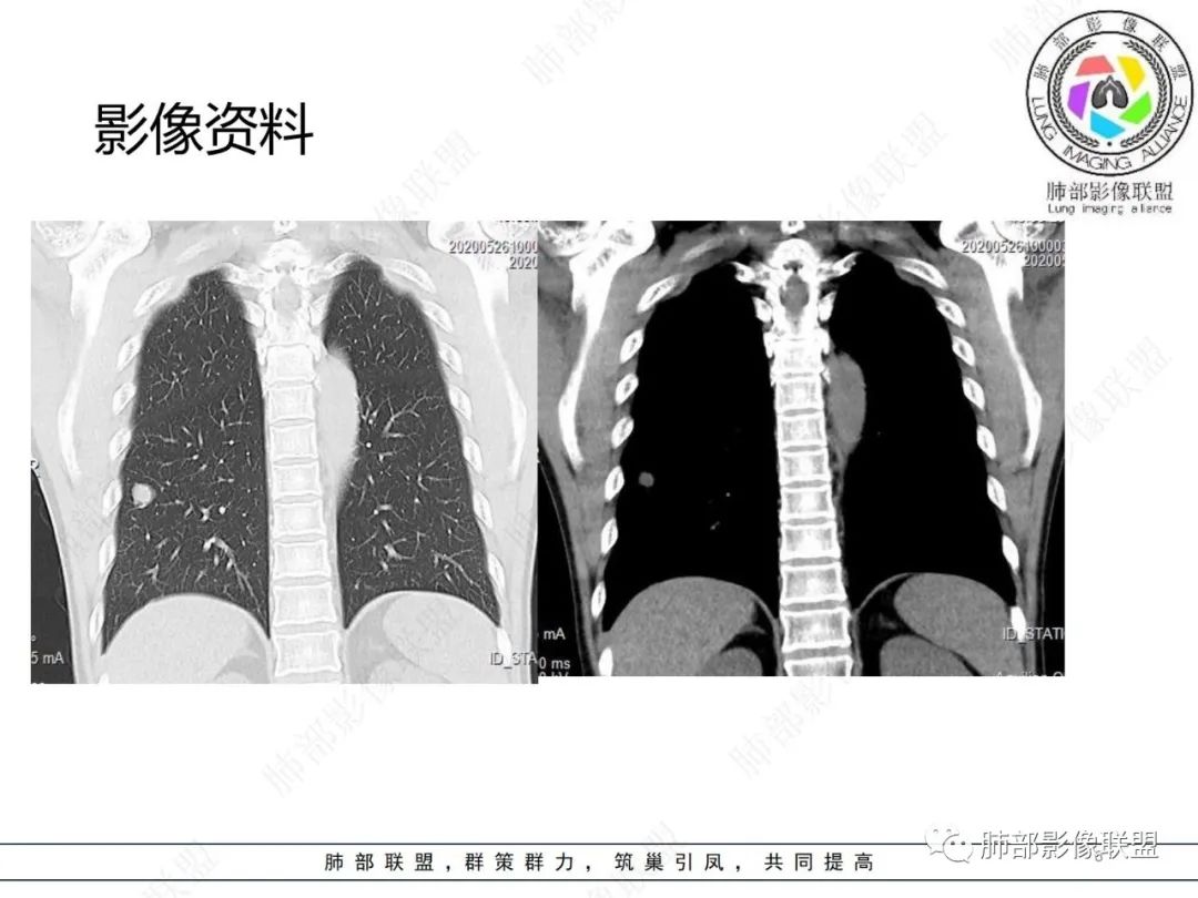 影像PPT - 【病例】肺内光滑实性结节的分析-6 影像PPT - 【病例】肺内光滑实性结节的分析-6