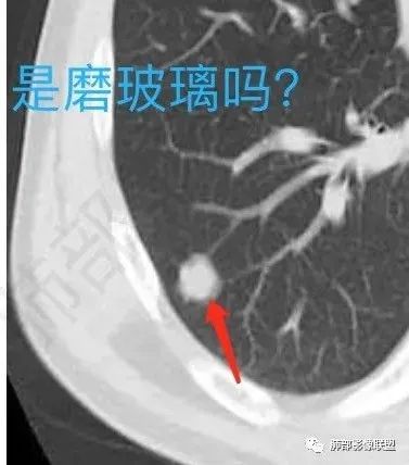 影像PPT - 【病例】肺内光滑实性结节的分析-20 影像PPT - 【病例】肺内光滑实性结节的分析-20
