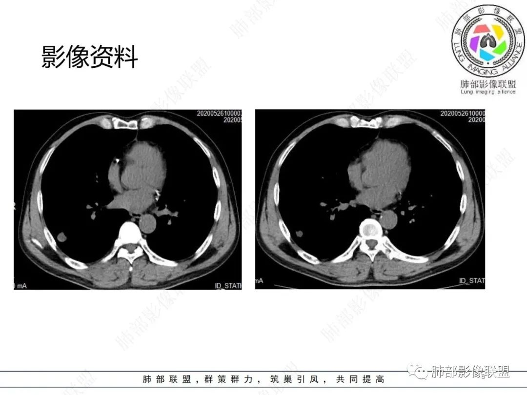 影像PPT - 【病例】肺内光滑实性结节的分析-5 影像PPT - 【病例】肺内光滑实性结节的分析-5