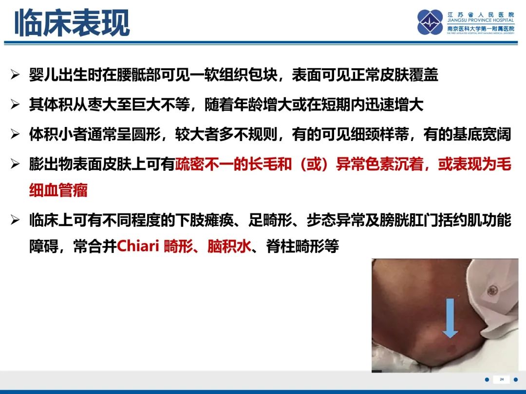 影像PPT - 【PPT】脂肪脊髓脊膜膨出-25