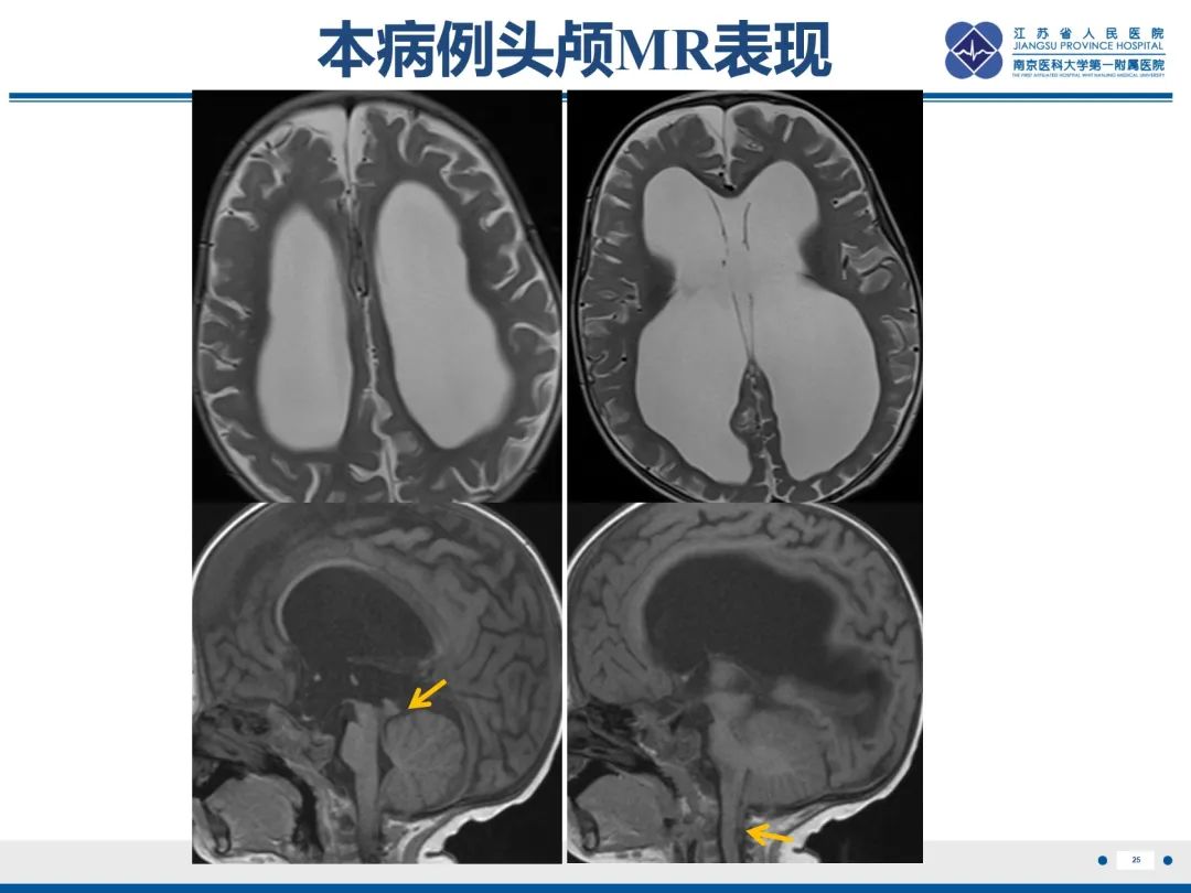 影像PPT - 【PPT】脂肪脊髓脊膜膨出-26