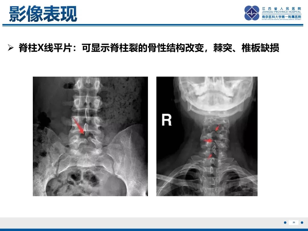 影像PPT - 【PPT】脂肪脊髓脊膜膨出-27