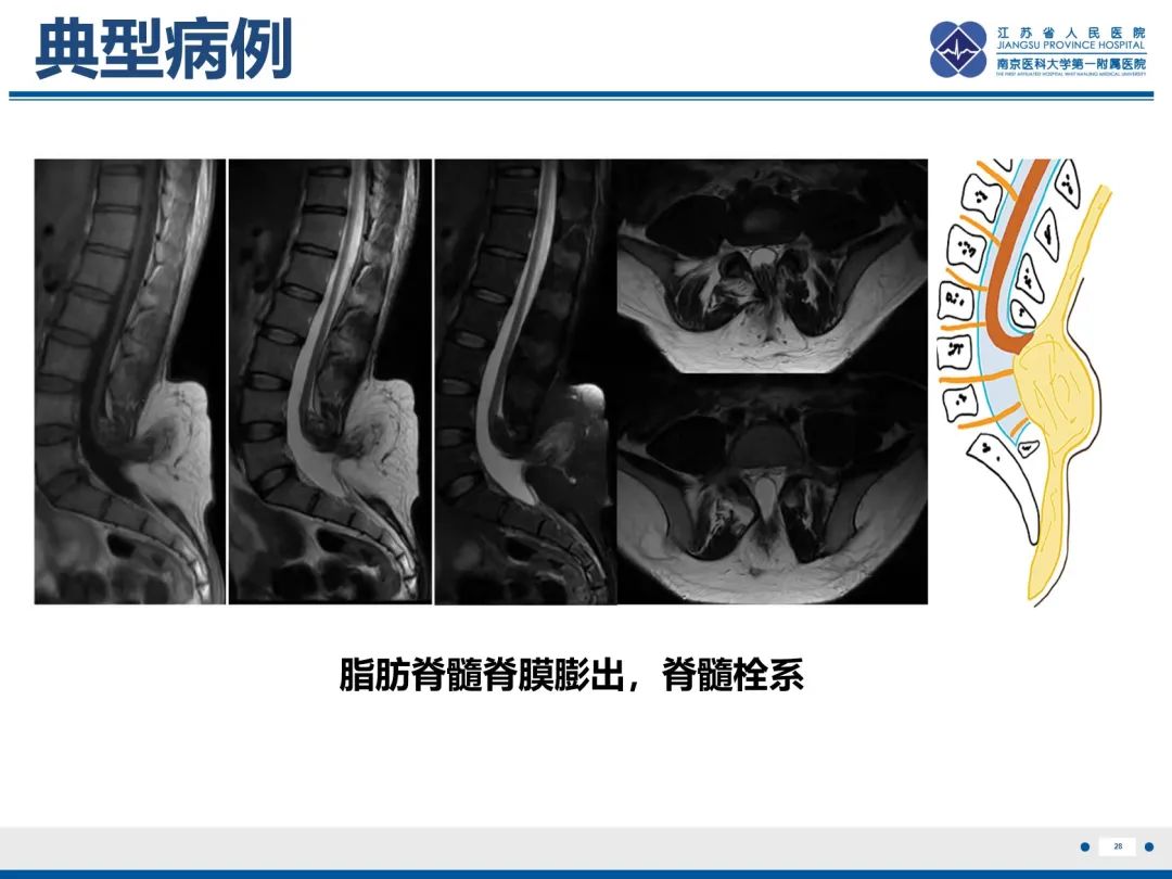 影像PPT - 【PPT】脂肪脊髓脊膜膨出-29