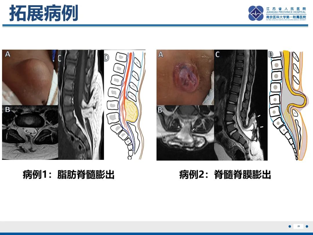 影像PPT - 【PPT】脂肪脊髓脊膜膨出-30
