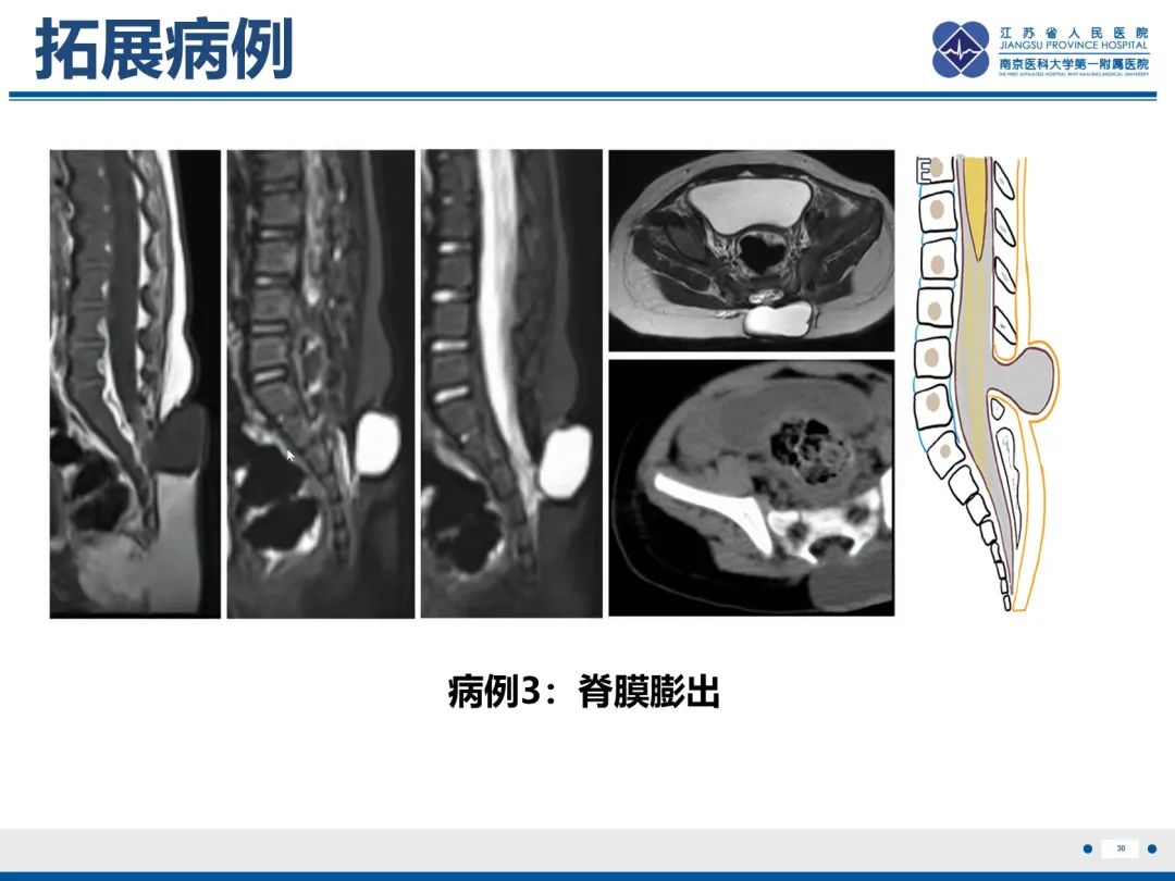 影像PPT - 【PPT】脂肪脊髓脊膜膨出-31