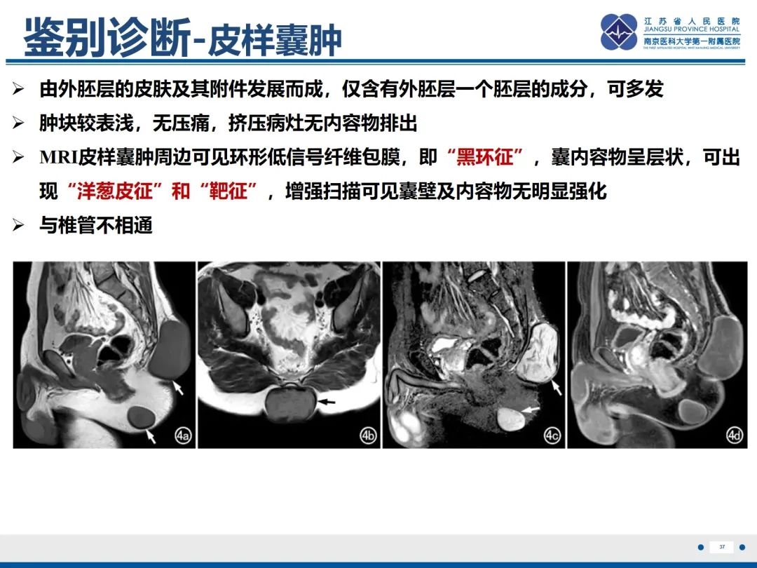 影像PPT - 【PPT】脂肪脊髓脊膜膨出-38