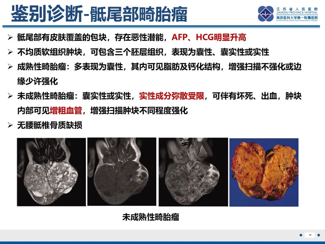 影像PPT - 【PPT】脂肪脊髓脊膜膨出-37