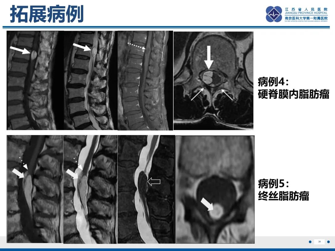 影像PPT - 【PPT】脂肪脊髓脊膜膨出-32