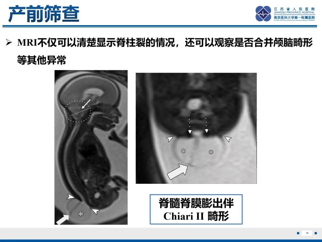 影像PPT - 【PPT】脂肪脊髓脊膜膨出-35