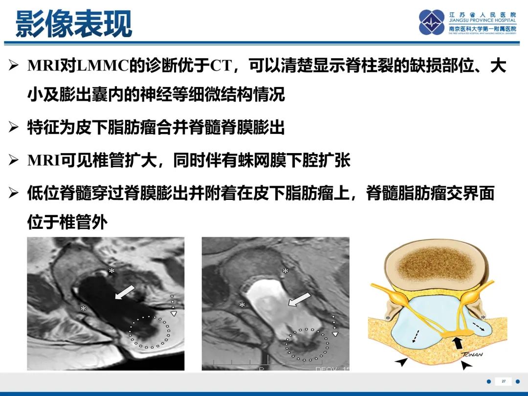影像PPT - 【PPT】脂肪脊髓脊膜膨出-28
