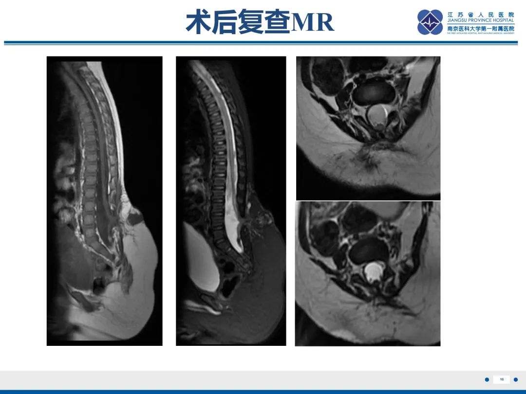 影像PPT - 【PPT】脂肪脊髓脊膜膨出-1