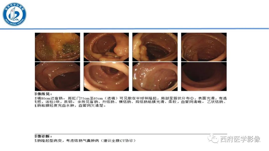 影像PPT - 【PPT】肠气囊肿影像诊断与鉴别-10