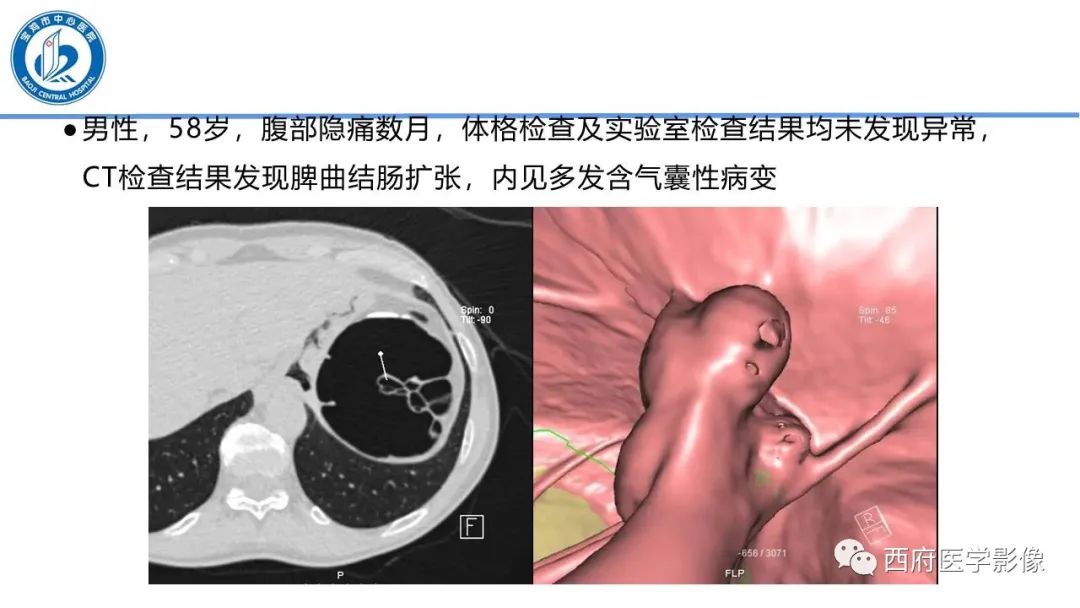 影像PPT - 【PPT】肠气囊肿影像诊断与鉴别-24