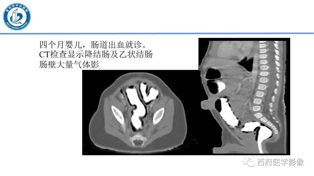 影像PPT - 【PPT】肠气囊肿影像诊断与鉴别-25