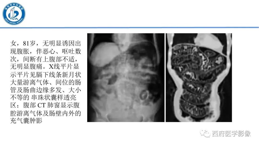 影像PPT - 【PPT】肠气囊肿影像诊断与鉴别-26
