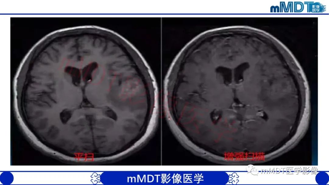 影像PPT - 【PPT】系统性红斑狼疮脑病-3 影像PPT - 【PPT】系统性红斑狼疮脑病-3