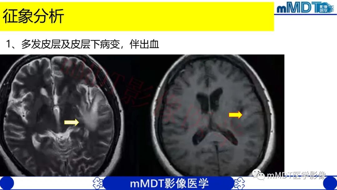 影像PPT - 【PPT】系统性红斑狼疮脑病-4 影像PPT - 【PPT】系统性红斑狼疮脑病-4