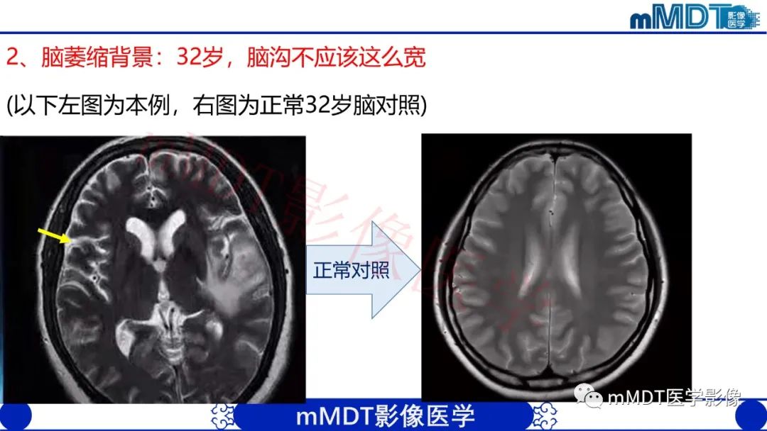 影像PPT - 【PPT】系统性红斑狼疮脑病-7 影像PPT - 【PPT】系统性红斑狼疮脑病-7