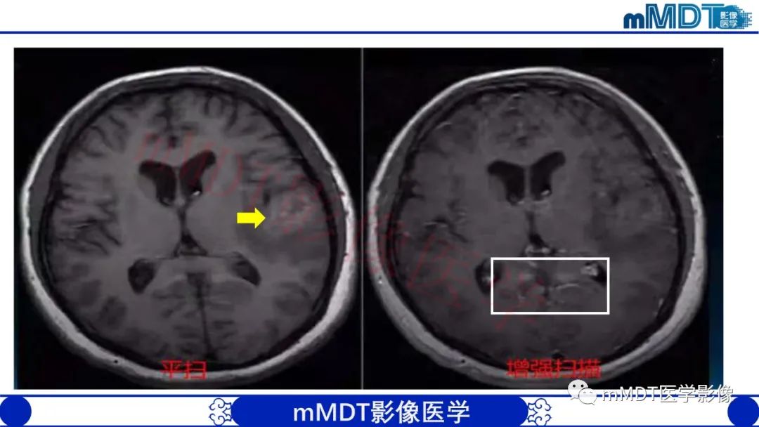 影像PPT - 【PPT】系统性红斑狼疮脑病-5 影像PPT - 【PPT】系统性红斑狼疮脑病-5