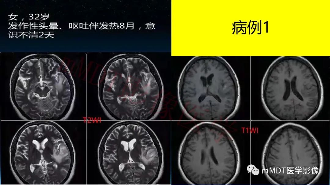 影像PPT - 【PPT】系统性红斑狼疮脑病-2 影像PPT - 【PPT】系统性红斑狼疮脑病-2